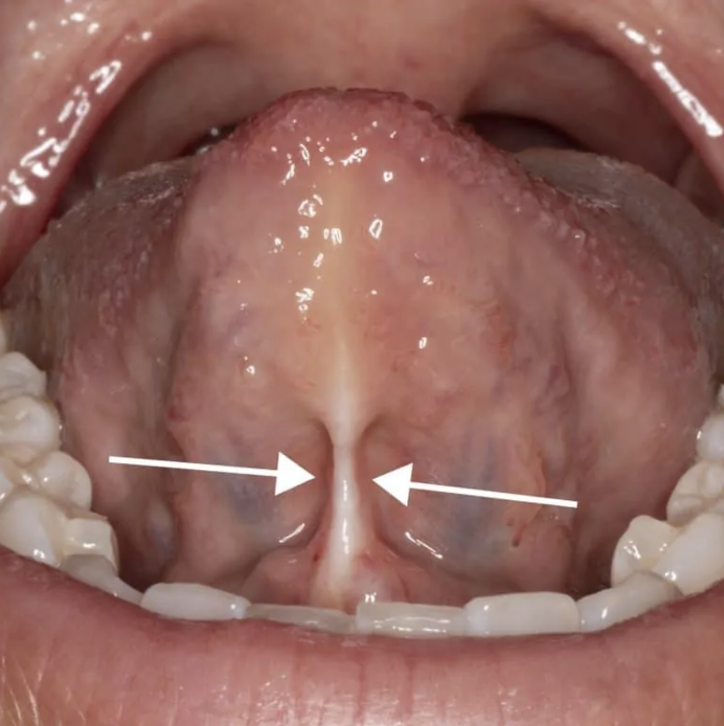 Lip/Tongue Ties - Virginia VA Doctor - Craniofacial Pain and Dental Sleep  Center of Virginia